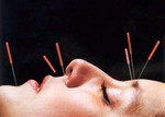 Foto Mooiere huid door prikken met acupunctuur?