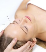 Foto Acupunctuur geeft even goede resultaten als botox