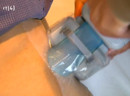 Foto Amerikaanse FDA keurt cryolipolyse goed voor het verwijderen van vetcellen