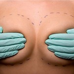 Foto IGZ wil kwaliteitsnormen bij borstvergrotingen